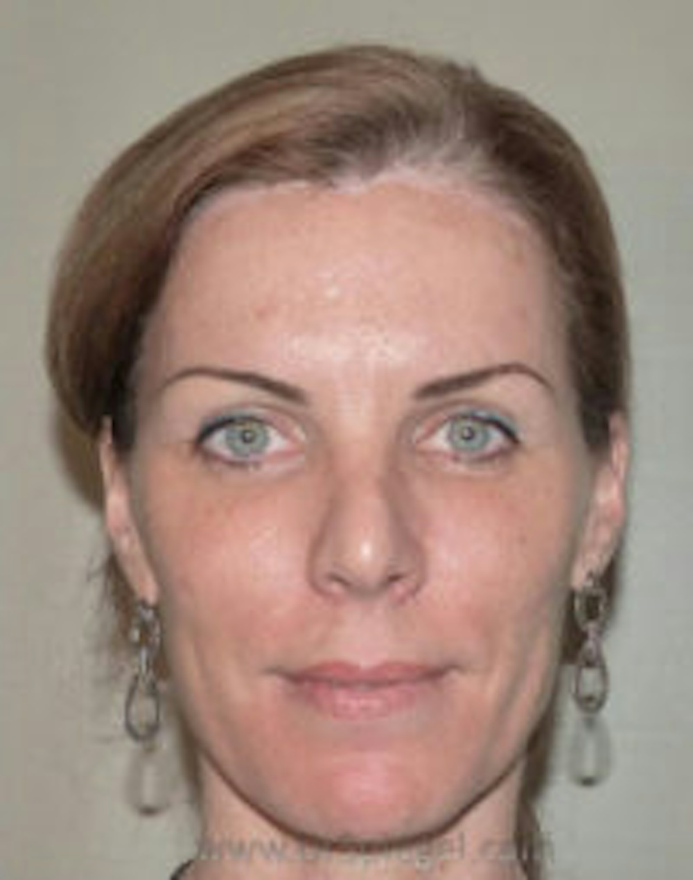 Hairline Advancement