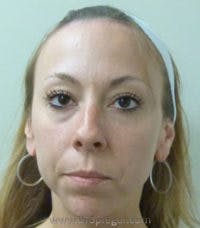 Scalp Advancement Before & After Gallery - Patient 918590 - Image 1