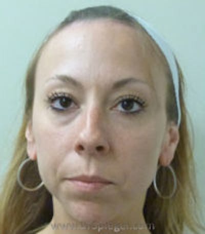 Scalp Advancement Before & After Gallery - Patient 129277 - Image 1