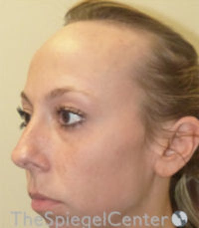 Scalp Advancement Before & After Gallery - Patient 129277 - Image 3