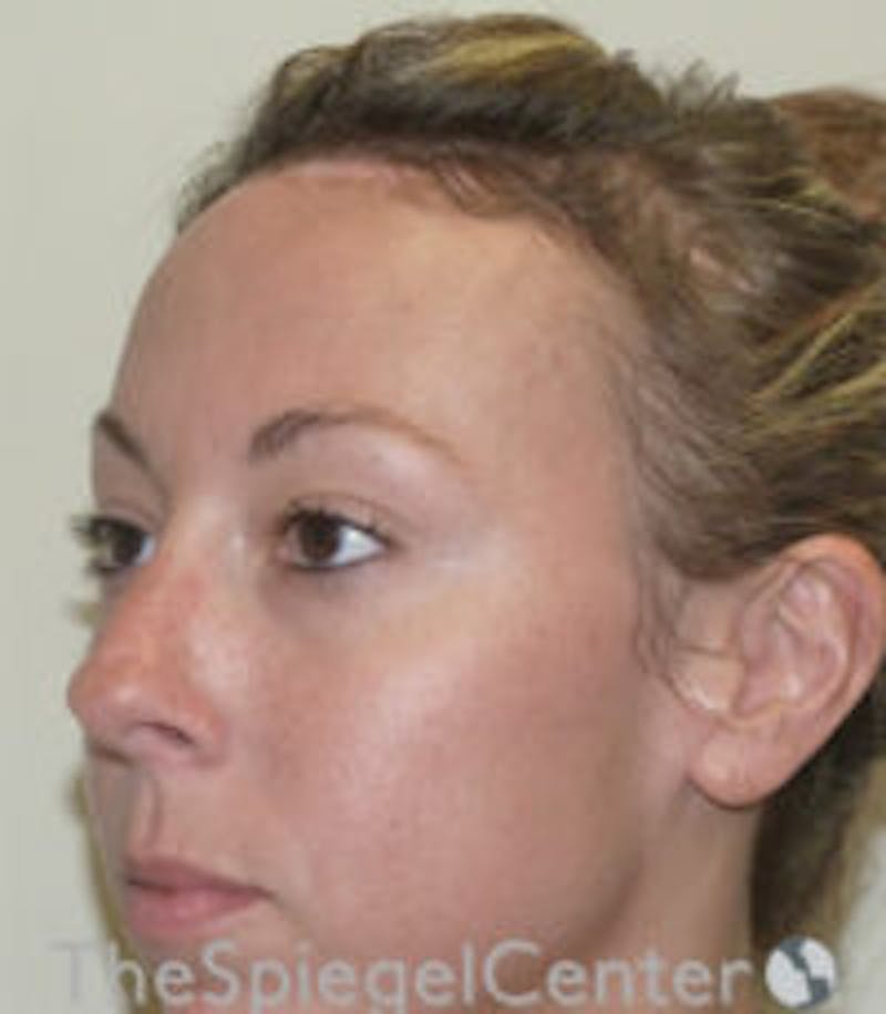 Scalp Advancement Before & After Gallery - Patient 918590 - Image 4