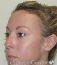 Scalp Advancement Before & After Gallery - Patient 918590 - Image 4