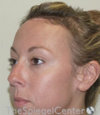 Scalp Advancement Before & After Gallery - Patient 129277 - Image 4