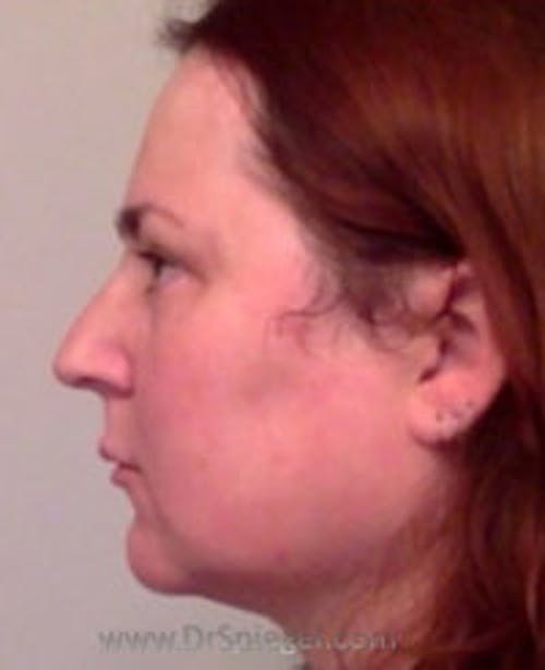 Scalp Advancement Before & After Gallery - Patient 382039 - Image 1