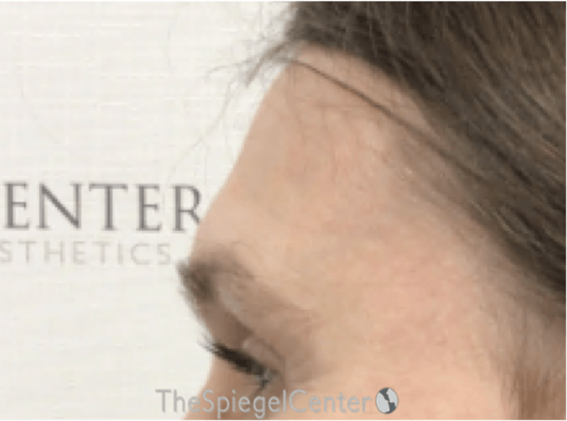 FFS Scalp Advancement Before & After Gallery - Patient 117349 - Image 3