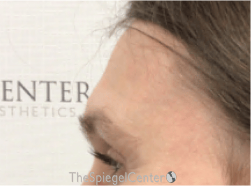Scalp Advancement Before & After Gallery - Patient 217125 - Image 3