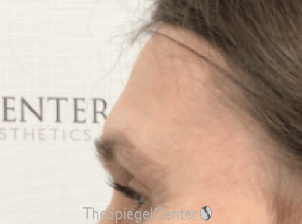 Scalp Advancement Before & After Gallery - Patient 217125 - Image 3