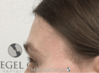 Scalp Advancement Before & After Gallery - Patient 217125 - Image 4