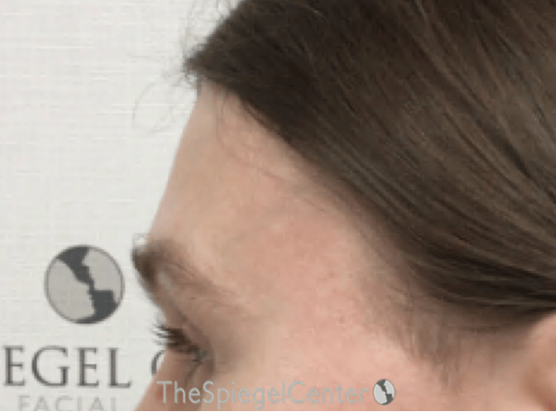 Scalp Advancement Before & After Gallery - Patient 217125 - Image 4