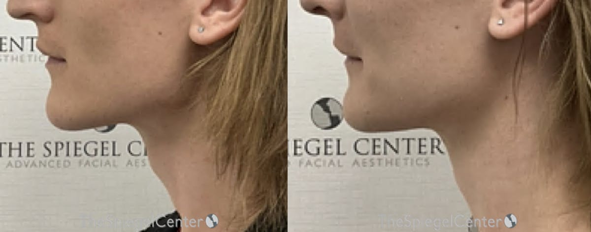 FFS Trachea Shave Before & After Gallery - Patient 126562 - Image 1