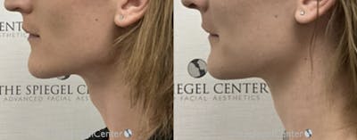 Trachea Shave Before & After Gallery - Patient 126562 - Image 1