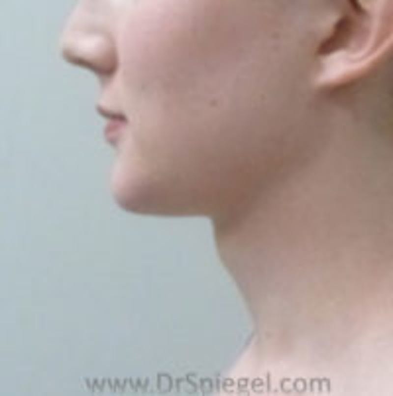 FFS Trachea Shave Before & After Gallery - Patient 108835 - Image 1