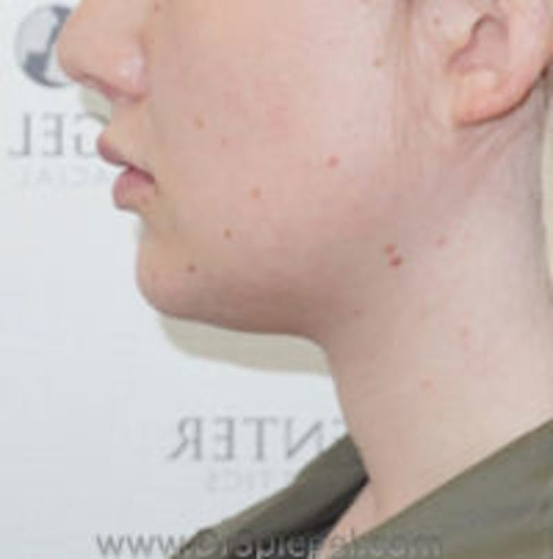 FFS Trachea Shave Before & After Gallery - Patient 108835 - Image 2