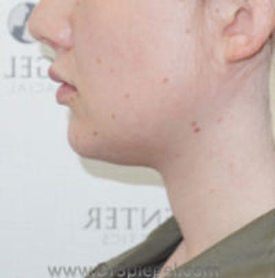 Trachea Shave Before & After Gallery - Patient 108835 - Image 2