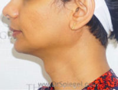 Trachea Shave Before & After Gallery - Patient 139381 - Image 1