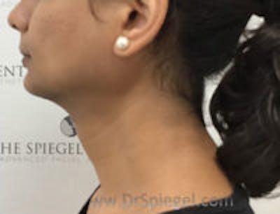 Trachea Shave Before & After Gallery - Patient 139381 - Image 2