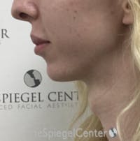 FFS Trachea Shave Before & After Gallery - Patient 420381 - Image 1