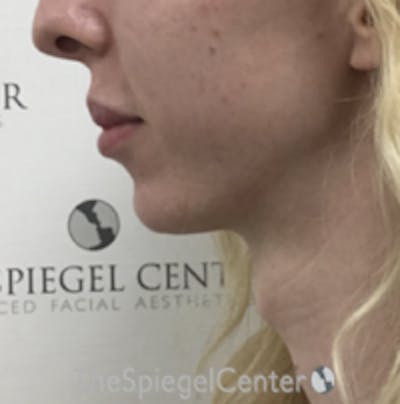 Trachea Shave Before & After Gallery - Patient 420381 - Image 1