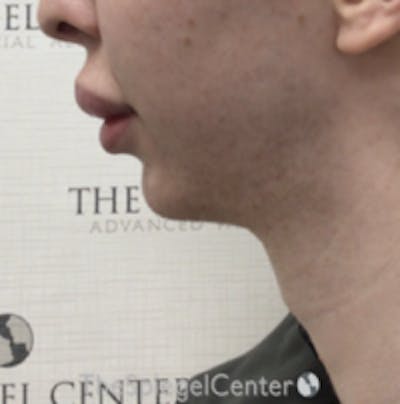 Trachea Shave Before & After Gallery - Patient 420381 - Image 2