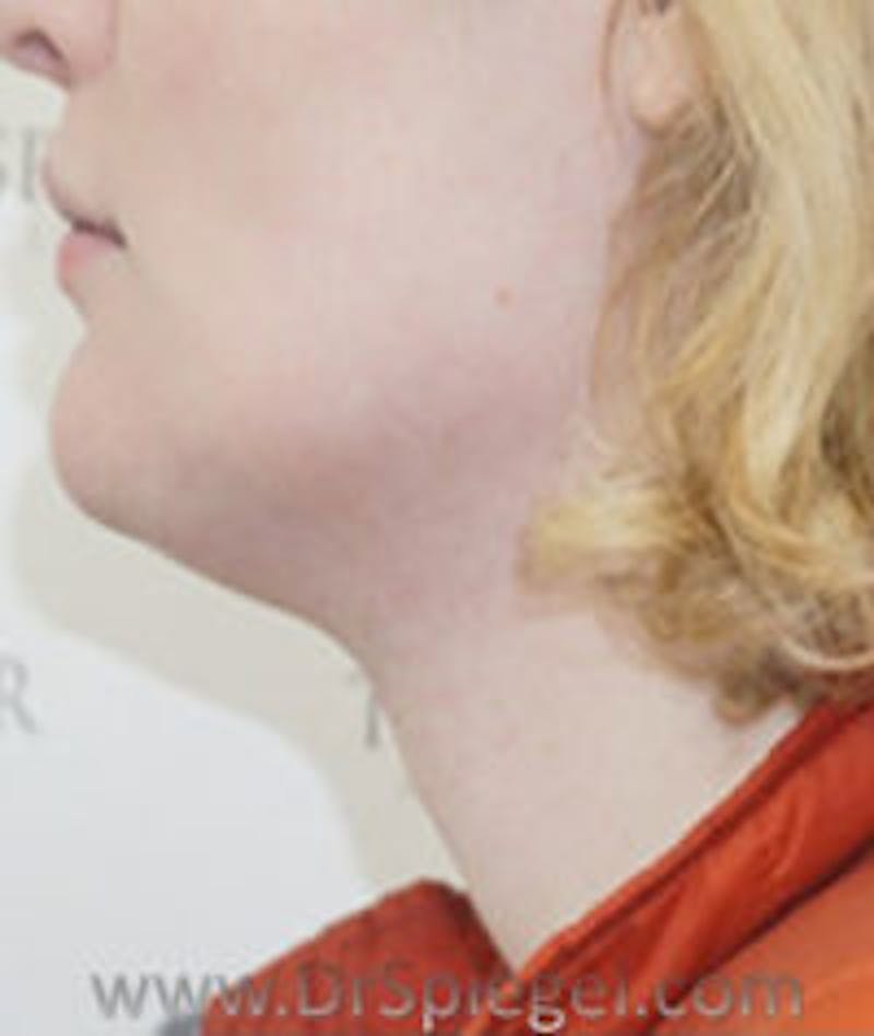 FFS Trachea Shave Before & After Gallery - Patient 153882 - Image 2