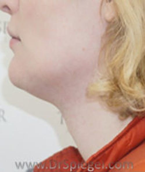 FFS Trachea Shave Before & After Gallery - Patient 153882 - Image 2
