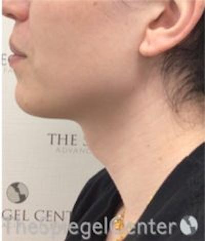 Trachea Shave Before & After Gallery - Patient 376606 - Image 1