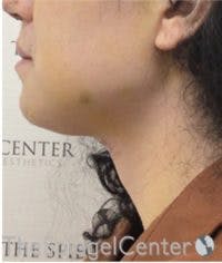 FFS Trachea Shave Before & After Gallery - Patient 376606 - Image 2