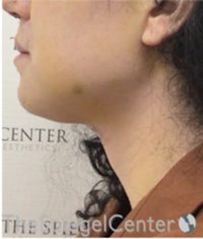 Trachea Shave Before & After Gallery - Patient 376606 - Image 2