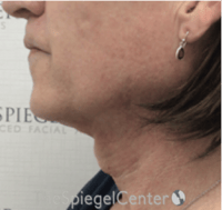 FFS Trachea Shave Before & After Gallery - Patient 381327 - Image 1