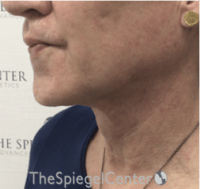FFS Trachea Shave Before & After Gallery - Patient 381327 - Image 2