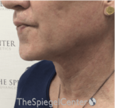 Trachea Shave Before & After Gallery - Patient 381327 - Image 2