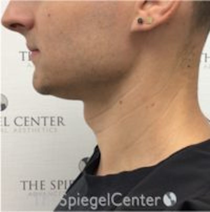 FFS Trachea Shave Before & After Gallery - Patient 168644 - Image 1