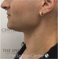 FFS Trachea Shave Before & After Gallery - Patient 168644 - Image 2