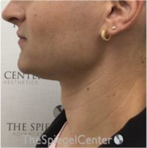 FFS Trachea Shave Before & After Gallery - Patient 168644 - Image 2
