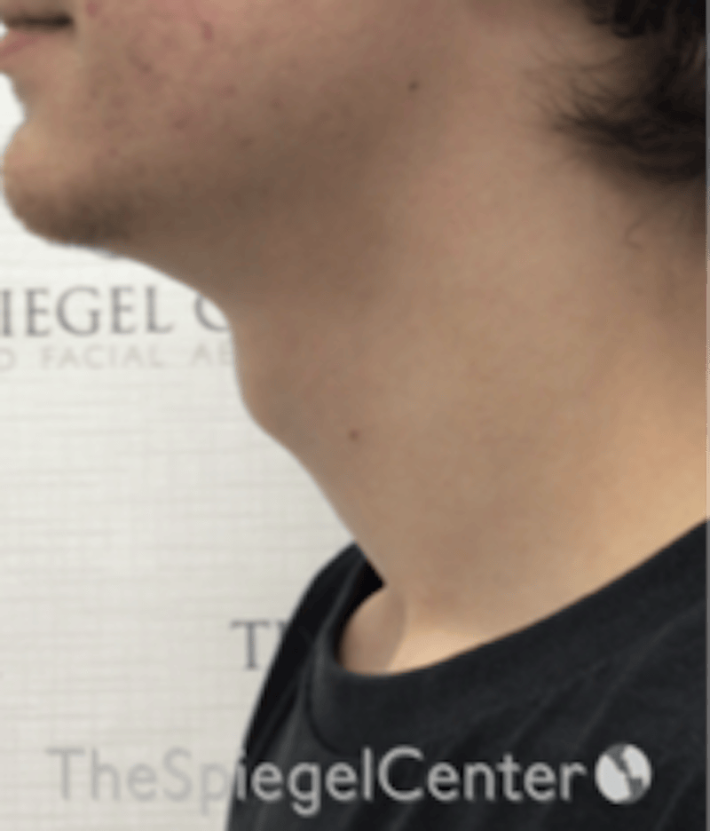 FFS Trachea Shave Before & After Gallery - Patient 374336 - Image 1