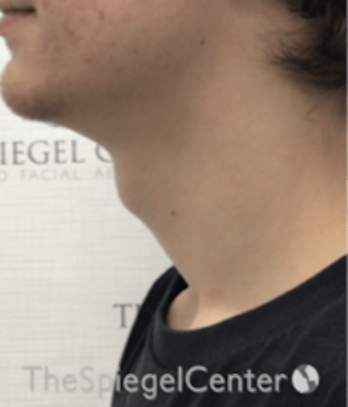 FFS Trachea Shave Before & After Gallery - Patient 374336 - Image 1