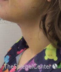 FFS Trachea Shave Before & After Gallery - Patient 374336 - Image 2