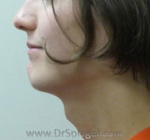 FFS Trachea Shave Before & After Gallery - Patient 262450 - Image 1