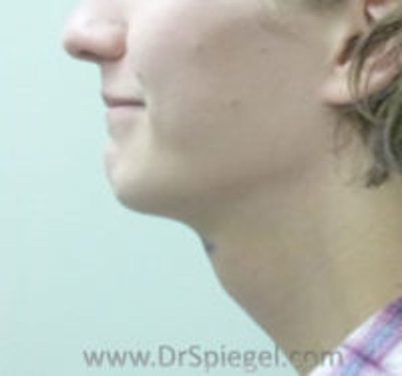FFS Trachea Shave Before & After Gallery - Patient 262450 - Image 2