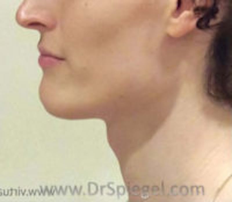 FFS Trachea Shave Before & After Gallery - Patient 428491 - Image 1