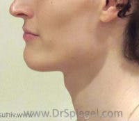 FFS Trachea Shave Before & After Gallery - Patient 428491 - Image 1
