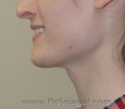 Trachea Shave Before & After Gallery - Patient 428491 - Image 2