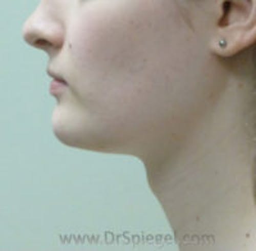 FFS Trachea Shave Before & After Gallery - Patient 389578 - Image 1
