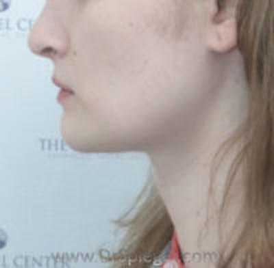 Trachea Shave Before & After Gallery - Patient 389578 - Image 2