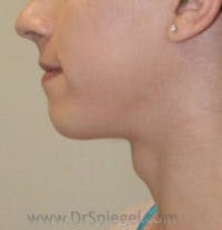 FFS Trachea Shave Before & After Gallery - Patient 392988 - Image 1