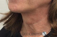 FFS Trachea Shave Before & After Gallery - Patient 169344 - Image 1