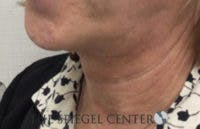 FFS Trachea Shave Before & After Gallery - Patient 169344 - Image 2