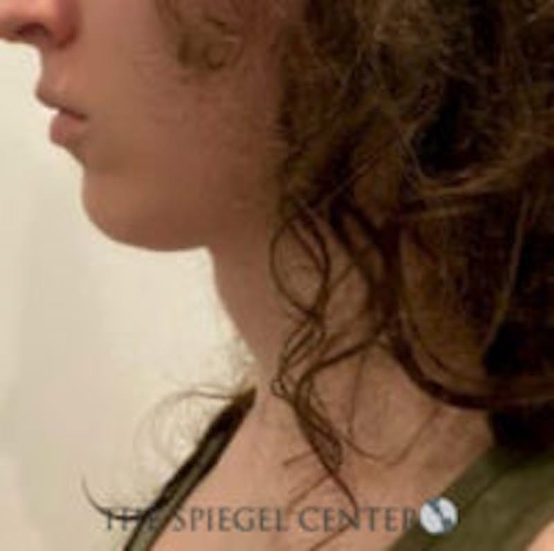 FFS Trachea Shave Before & After Gallery - Patient 381107 - Image 2