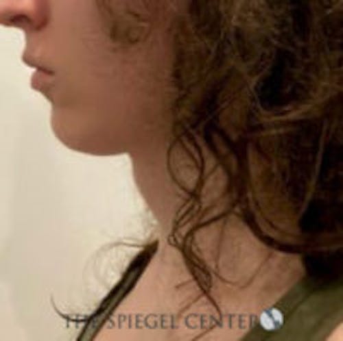 FFS Trachea Shave Before & After Gallery - Patient 381107 - Image 2