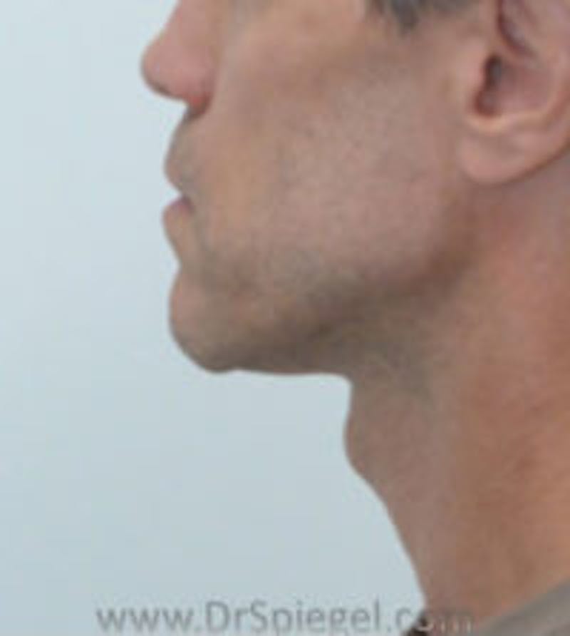 FFS Trachea Shave Before & After Gallery - Patient 270781 - Image 1